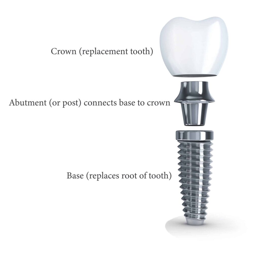 Diagram of a dental implant with three labeled parts: the crown (replacement tooth) at the top, the abutment (connector) in the middle, and the base (replaces root of tooth) at the bottom.