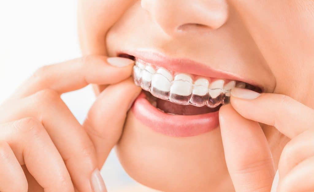 A person is smiling while placing a clear orthodontic aligner over their upper teeth with both hands.