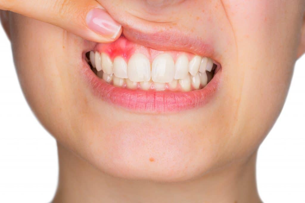 gingivitis treatment citrus heights dental emergency dental care
