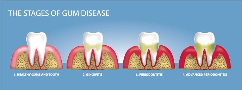 Diagram showing four stages of gum disease: healthy gums and tooth, gingivitis, periodontitis, and advanced periodontitis, with gums and bone receding as the disease progresses.