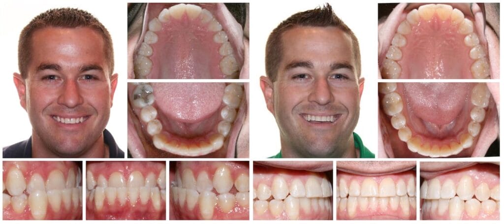 A collage showing a man smiling before and after dental treatment, with close-up photos of his teeth from different angles and views of the roof of his mouth, highlighting changes in alignment.