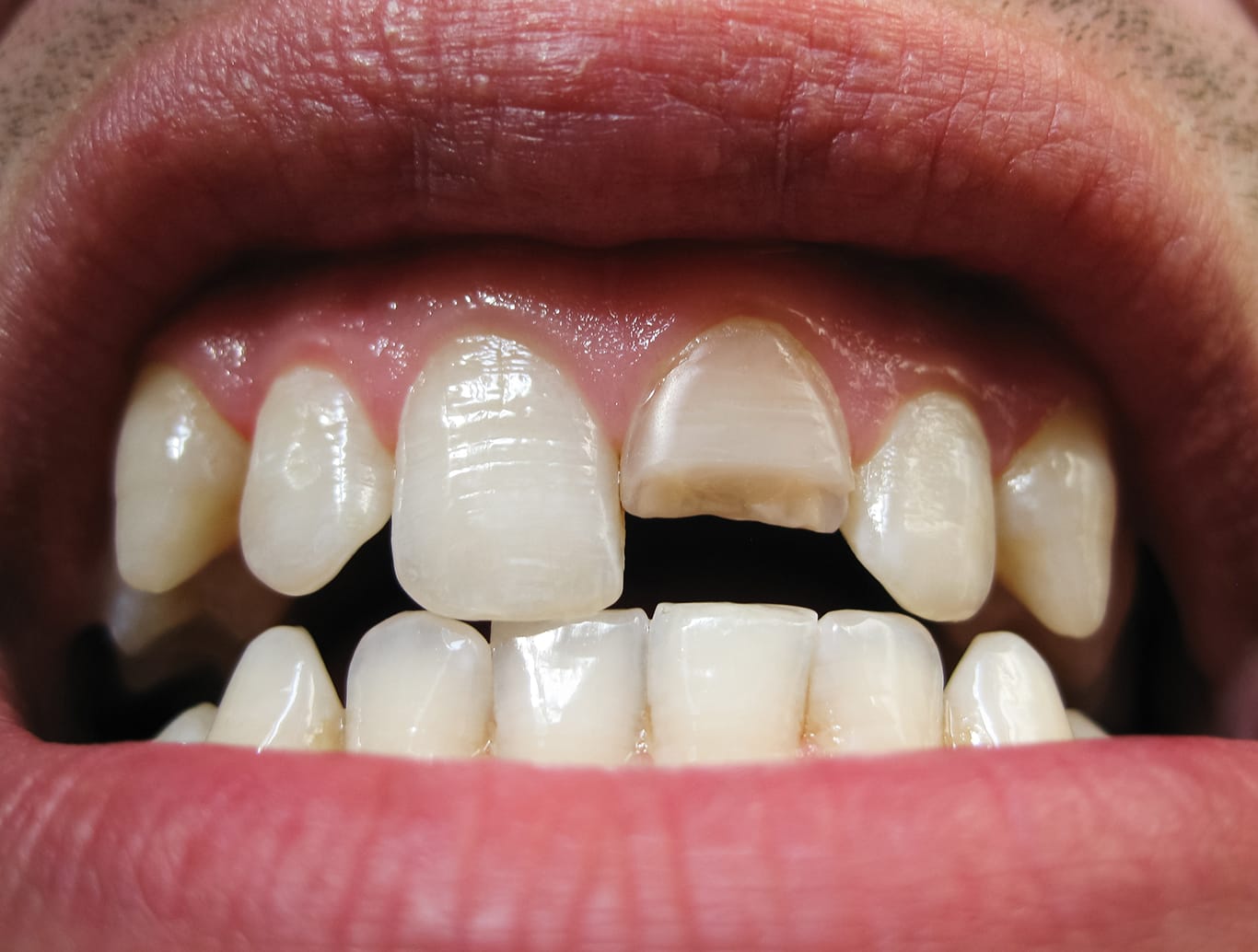 Close-up of an open mouth showing upper front teeth, one of which is chipped—a common dental emergency. The teeth are uneven and slightly yellowish, with visible gums, highlighting potential causes of toothaches or risk of abscess.