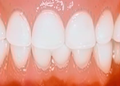 Close-up view of clean, white upper and lower teeth with noticeable dental crowding, particularly where the lower front teeth overlap each other against the pink gums—a concern often addressed in periodontal and gum disease treatment.