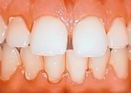 A close-up view of human teeth showing an overbite, where the upper front teeth significantly overlap the lower front teeth—a condition that may require periodontal care or gum disease treatment.