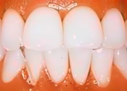 Close-up of a person's mouth showing very white, evenly aligned teeth, likely dental veneers or crowns, with gums visible—highlighting the importance of periodontal care and gum disease treatment for maintaining healthy gums.