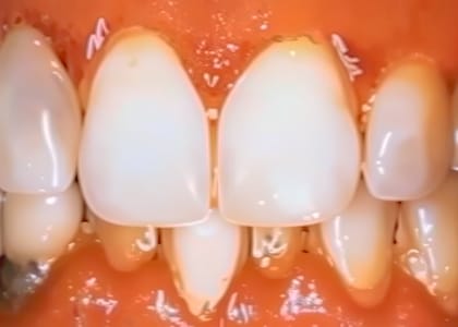 Close-up of human teeth showing slight gaps between the two upper front teeth and the teeth beside them, with healthy gums visible—ideal for illustrating periodontal health and the benefits of gum disease treatment.