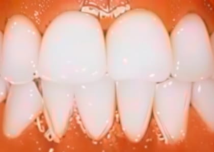 A close-up view of a set of white, perfectly aligned artificial teeth, likely dental veneers or crowns, with healthy gums visible—ideal results often seen after periodontal care or gum disease treatment.