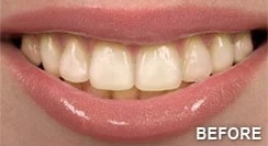 Teeth Whitening in Citrus Heights, CA | Brighten Your Smile Fast