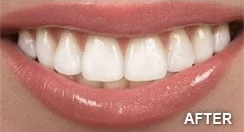 A close-up of a smiling mouth with bright white, straight teeth and glossy lips showcases the results of teeth whitening. The word "AFTER" appears in the lower right corner, suggesting a dental or cosmetic improvement.