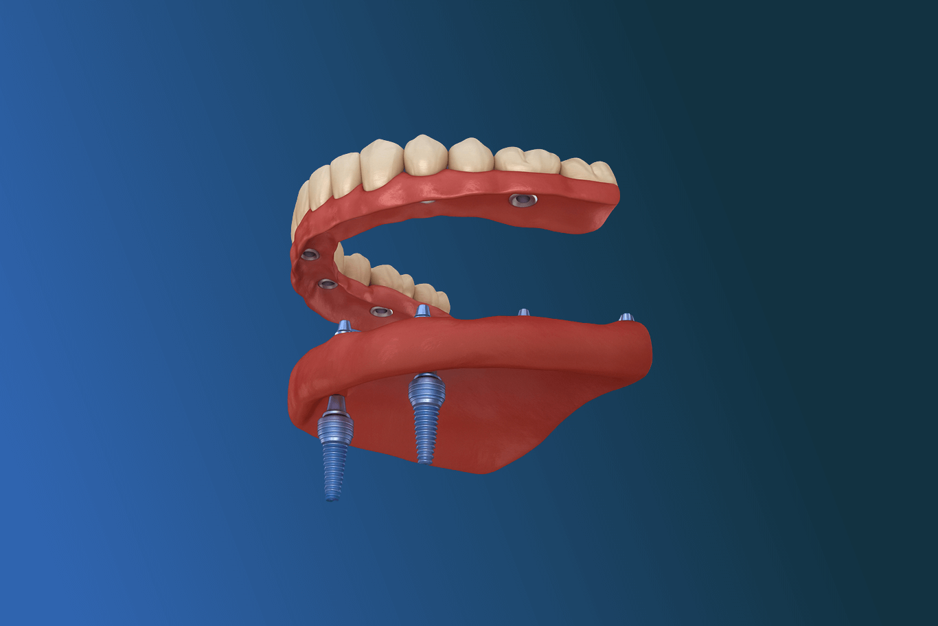 Rejuvenating Dentures in Citrus Heights, CA | Comfort and Natural Fit