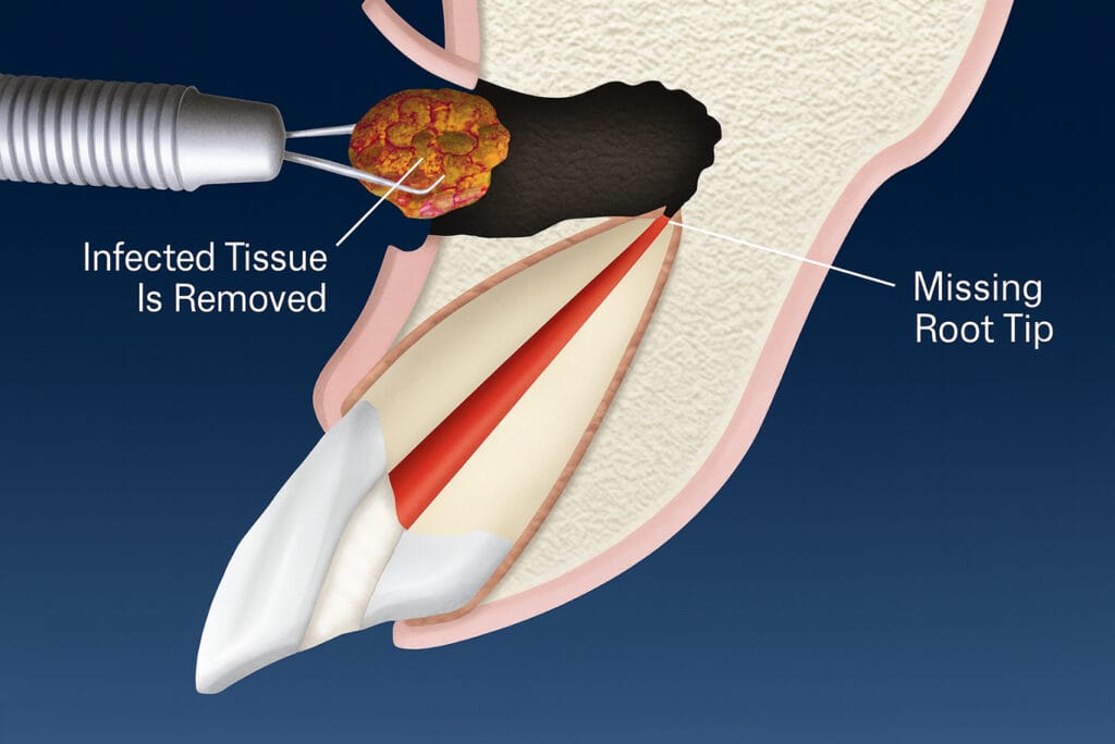 Endodontics in Citrus Heights, CA | Root Canal Treatment