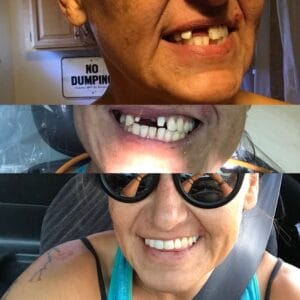 A three-panel image shows a woman’s dental transformation: top, missing a front tooth; middle, a dental procedure in progress; bottom, smiling confidently with a full set of teeth and wearing sunglasses.