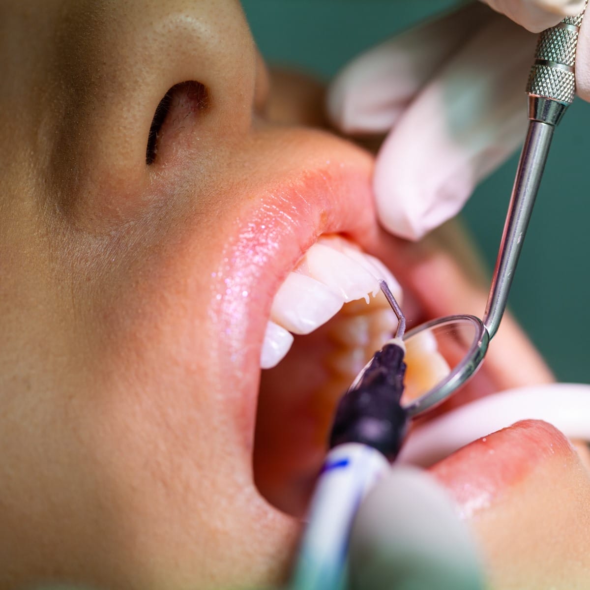 Close-up of a person's open mouth during a dental procedure, showing dentists' gloved hands using tools to clean or examine the teeth and gums.