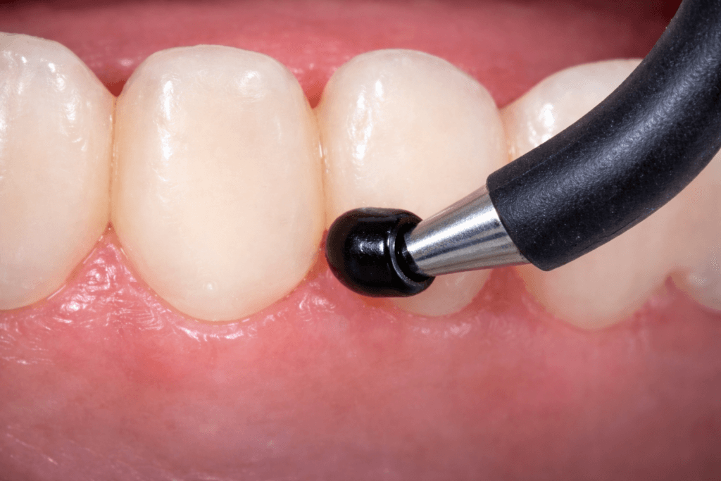 Close-up of a dental tool applying treatment or polish to the surface of a patient’s teeth near the gum line during oral care as part of dental diagnostic services.
