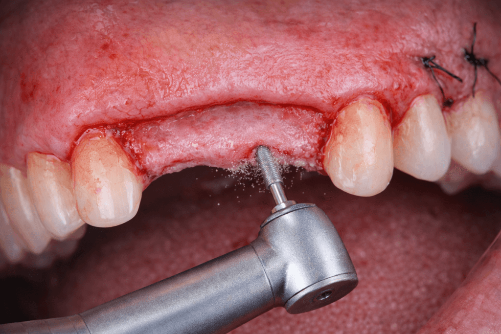 A close-up of a dental procedure showing a dental drill being used on the upper gums, with missing teeth and stitches visible in the gum tissue.