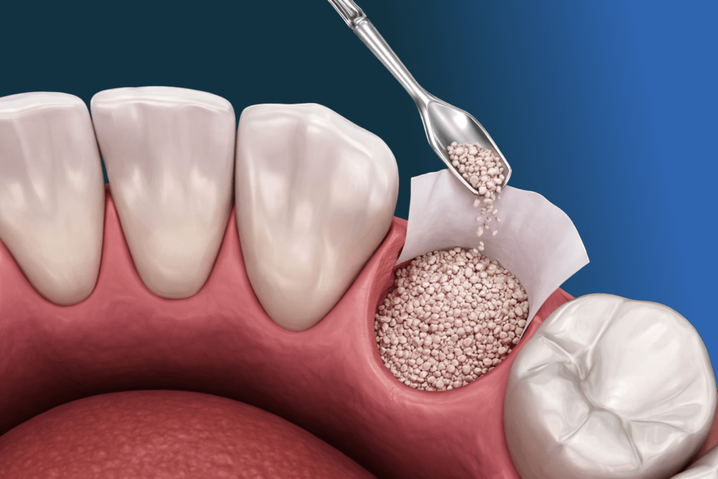 A dental illustration shows bone graft granules being placed into a tooth socket during oral surgery, with a dental tool applying the material on pink gum tissue beside natural teeth and a molar.
