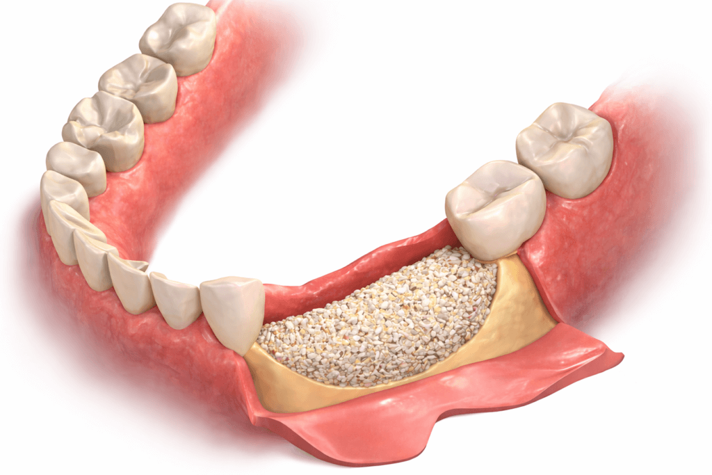 A 3D medical illustration of a lower jaw with teeth shows a bone graft material filling a section of the jawbone, commonly used to prepare for dental implants or to restore bone loss.