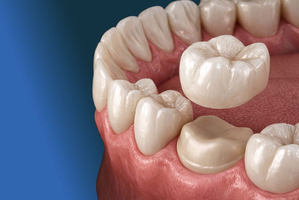 A close-up 3D illustration of a dental crown being placed on a molar tooth in the lower jaw, highlighting detailed gum tissue and surrounding teeth against a blue background—perfect for showcasing professional dentistry services.