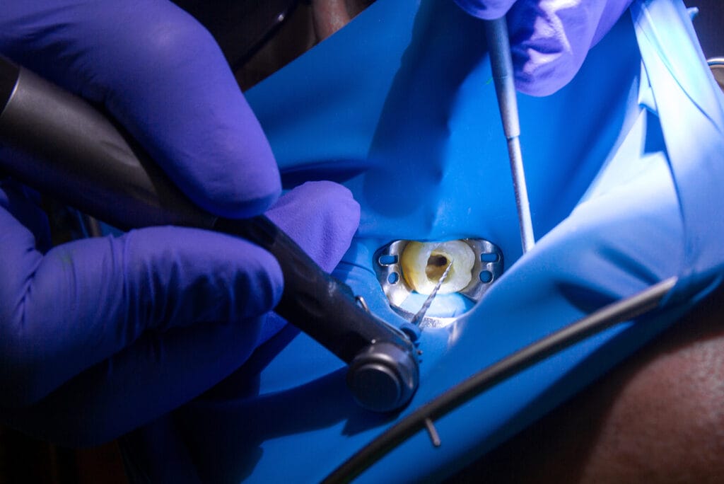 A close-up of a dentist wearing purple gloves performing a dental procedure on a patient, working on a tooth isolated with a blue dental dam and using dental instruments.