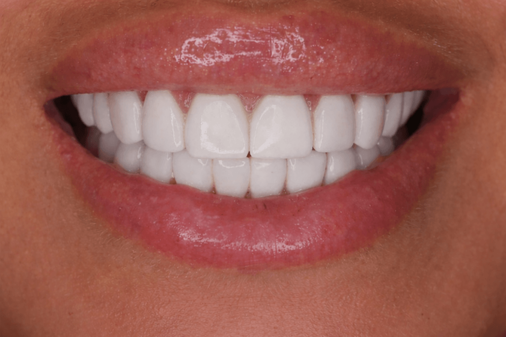 A close-up of a person's mouth smiling, showing clean, white teeth and smooth, healthy lips.