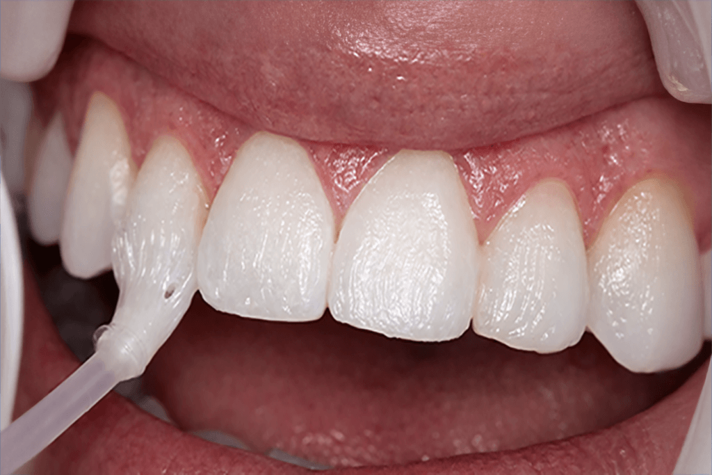 A close-up of a person's mouth showing clean, white upper front teeth and gums, with a cheek retractor and a dental suction tube in place for a dental procedure.