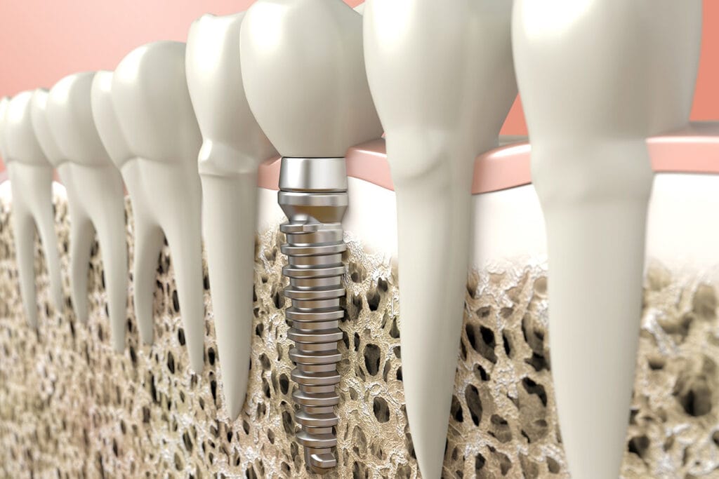 A 3D illustration showing a dental implant anchored in the jawbone among natural teeth, highlighting the metal screw and artificial crown structure.