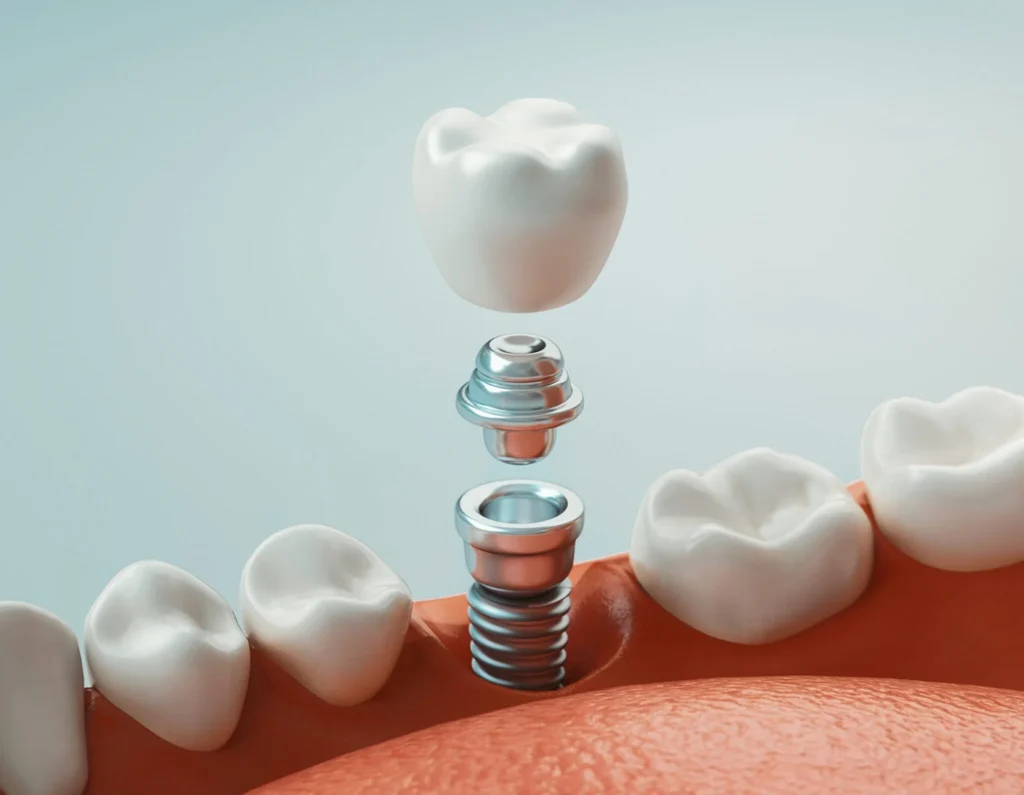 A 3D illustration showing a dental implant procedure: a gum with natural teeth, an inserted metal implant post, an abutment, and a dental crown being placed on top.