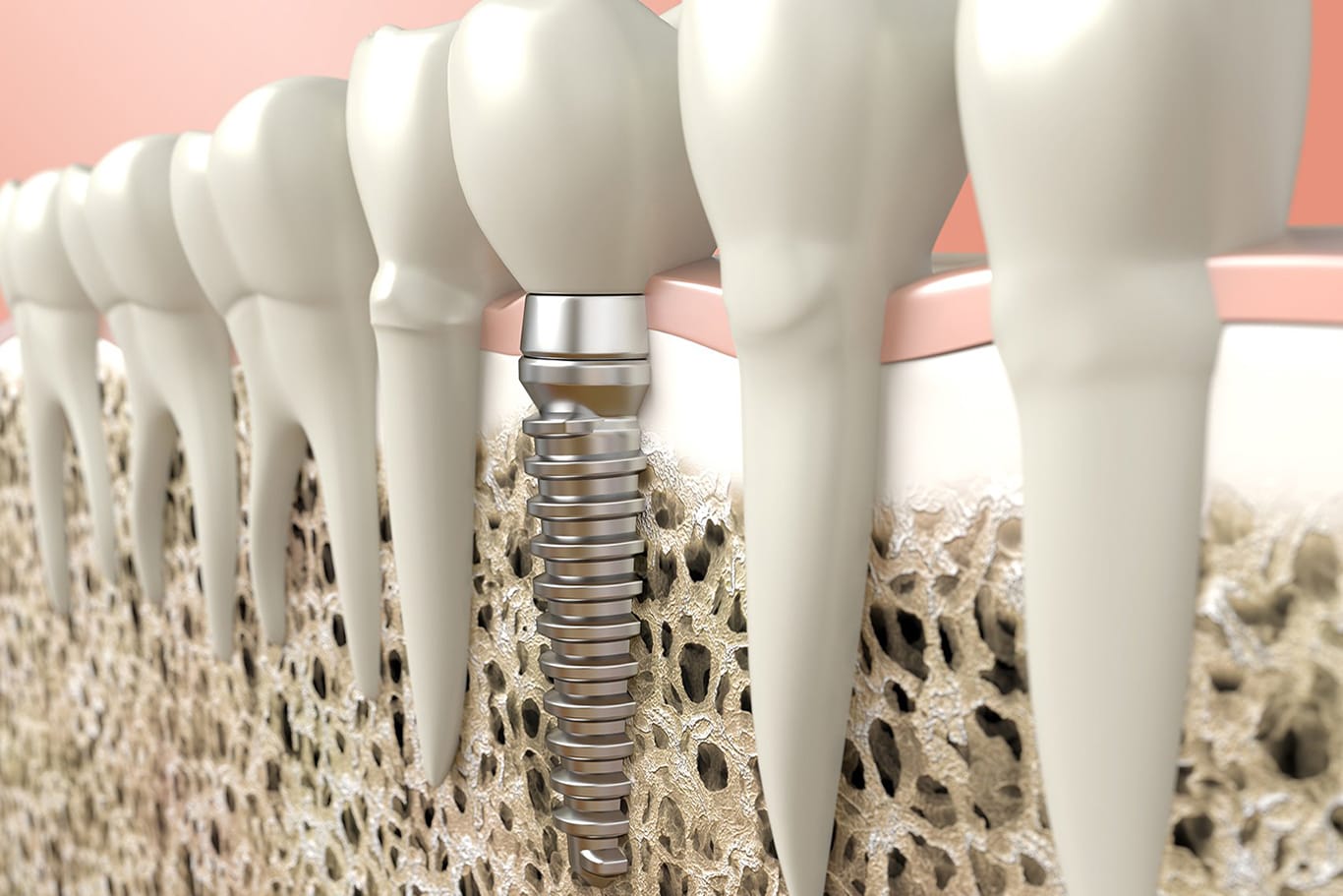 A 3D illustration showing a dental implant anchored in the jawbone among natural teeth, highlighting the metal screw and artificial crown structure.