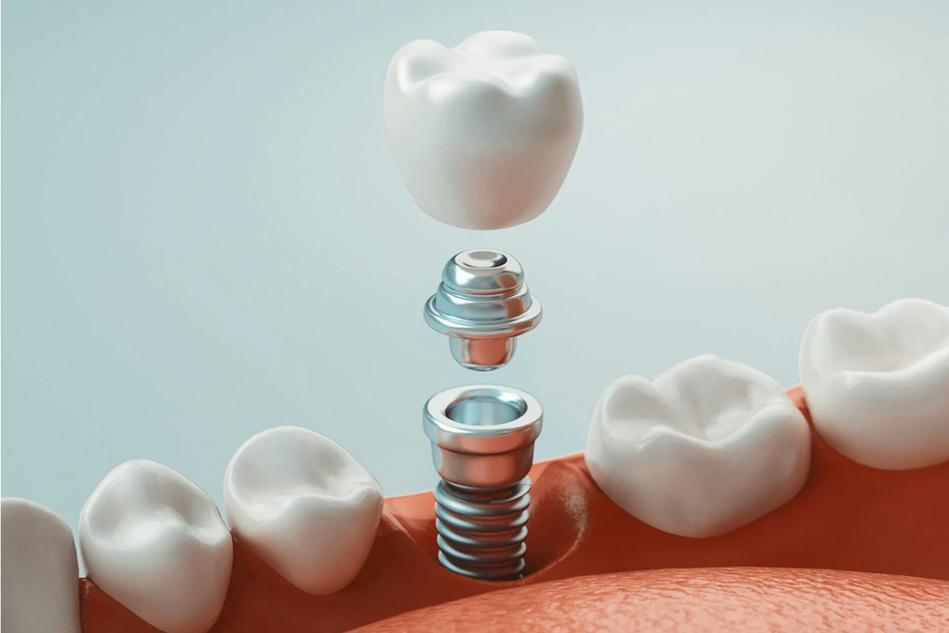 dental implants in citrus heights