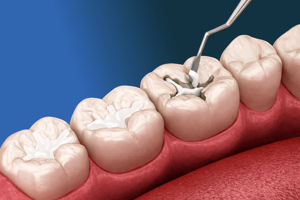 A close-up illustration of molar teeth shows a dental tool filling a cavity with dark material, while nearby teeth have white fillings—highlighting the importance of preventive services. The gums and tongue are also visible.