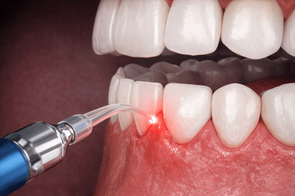 A close-up illustration of a dental laser treatment being applied to the gums near the teeth, showing a red light targeting the gum tissue for a dental procedure.