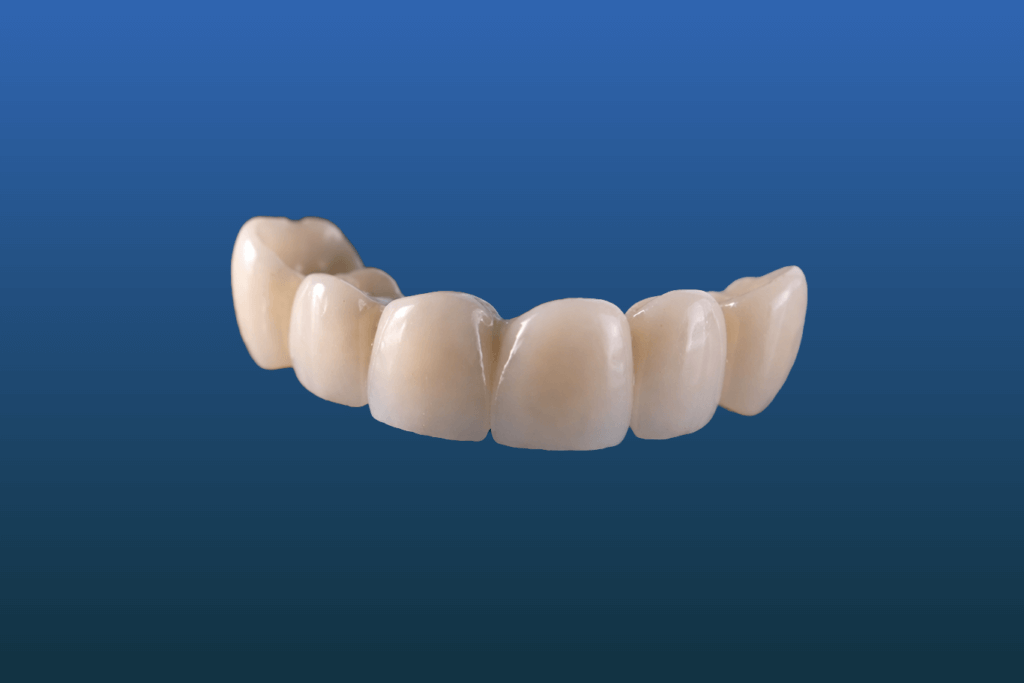 A dental bridge with six artificial teeth is displayed against a blue gradient background.