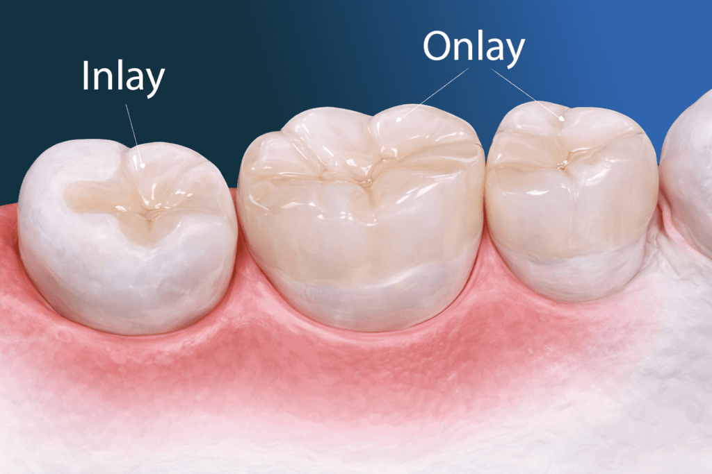 Illustration of three molar teeth showing dental restorations: the first tooth has an "Inlay" and the second an "Onlay," both labeled, highlighting the differences between these dentistry services.