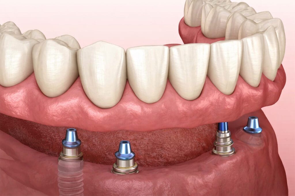A digital illustration shows four dental implants with metal abutments placed in the lower jaw, supporting a row of artificial teeth above the gums.