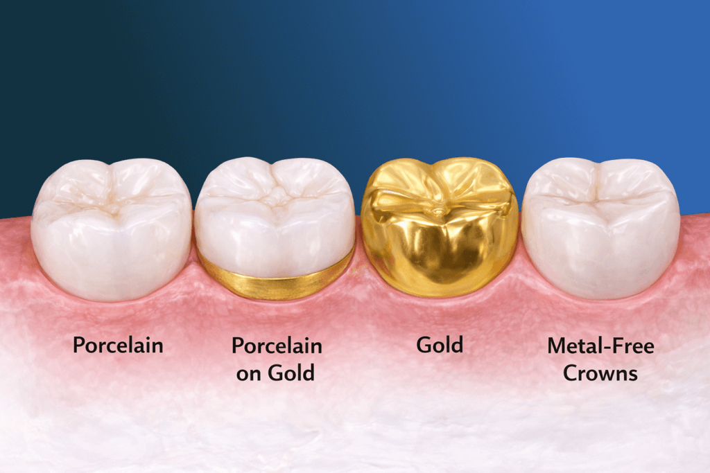 A diagram illustrates four types of dental crowns on gums—porcelain, porcelain on gold, gold, and metal-free—each labeled beneath the corresponding tooth to highlight available dentistry services.