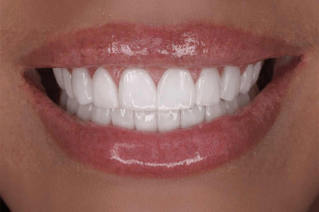 A close-up of a person's mouth smiling, showing straight, white teeth and glossy lips.