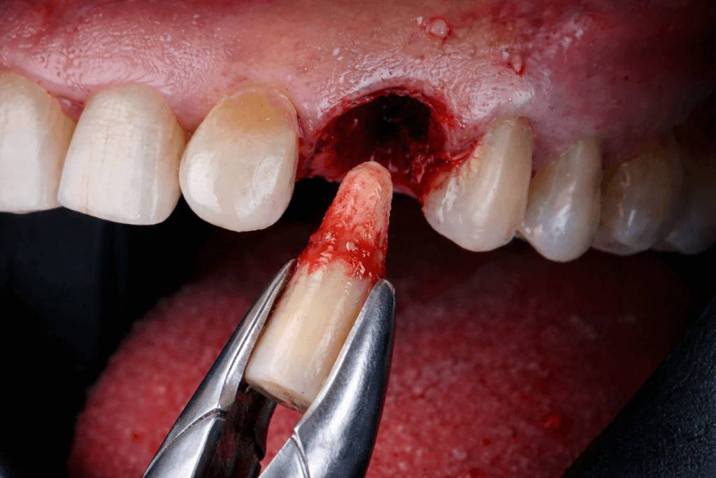 A close-up of dental forceps holding a freshly extracted, bloody front tooth in front of a patient’s open mouth, showing the gap and surrounding natural teeth.
